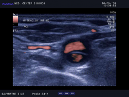 Ultrazvok vratnih žil - disekcija skupne karotide, prečno